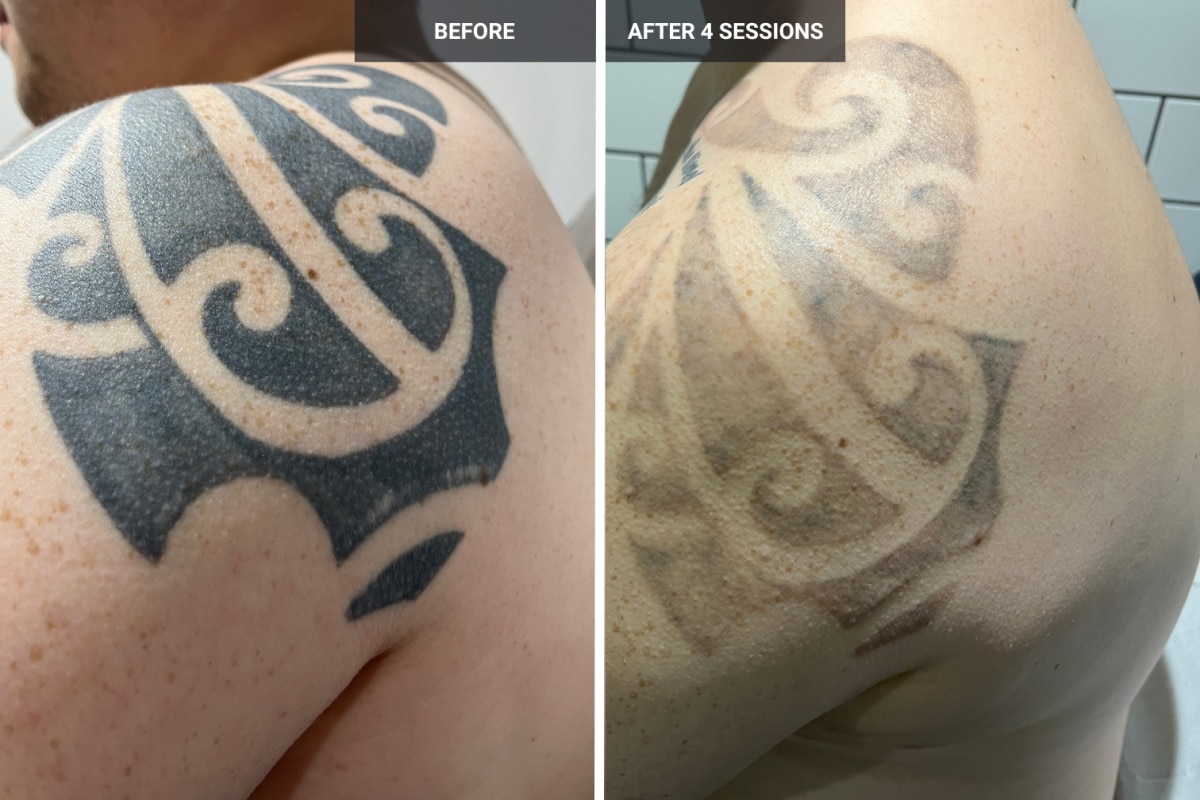 Why Some Tattoos Get Darker After A Laser Tattoo Removal Session