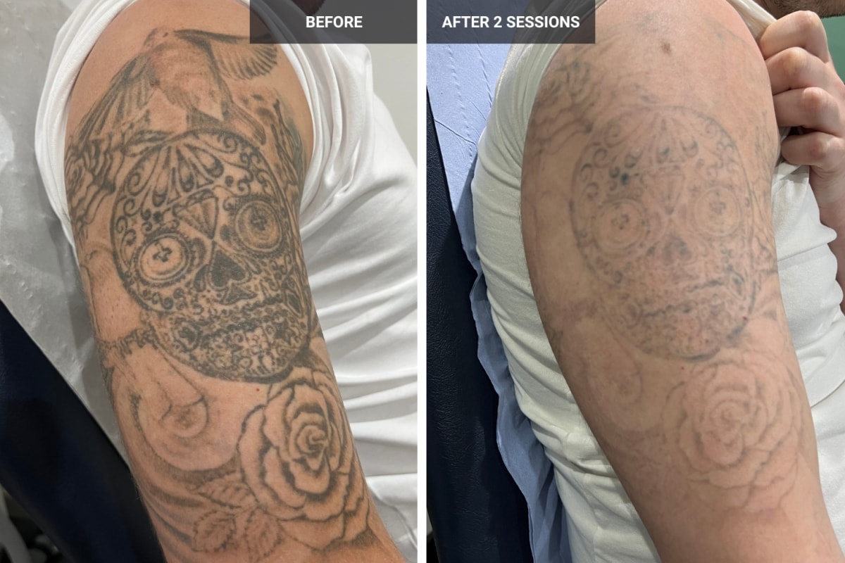 Thomas Bates - Laser Tattoo Removal