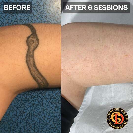 Arm tattoo removal, sleeve removal