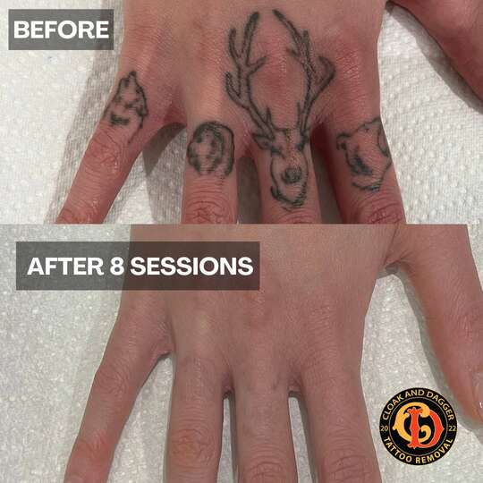 Finger tattoo removal