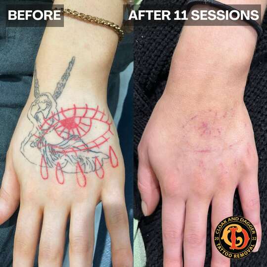 Hand tattoo removal for British Army enlistment
