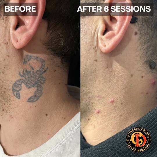 Neck tattoo removal for British Army enlistment