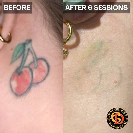 Neck tattoo removal results