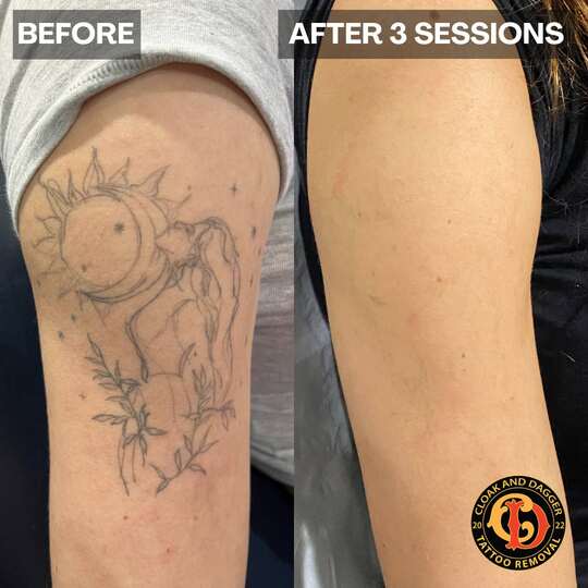 Shoulder tattoo removal